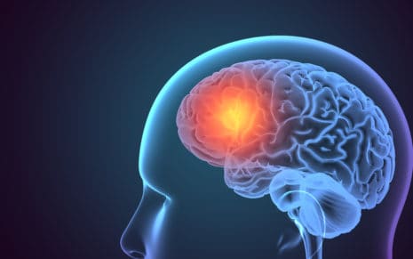 Zapalenie mózgu po szczepionce mRNA to realne zagrożenie zdrowia 11 x ray head with highligh in the brain - Na tym etapie pandemii pozostaje wiele pytań, a nasze rozumienie choroby szybko się rozwija. Niemniej jednak staramy się przedstawić tutaj krótki przegląd tego, jakich zmian neurokognitywnych można się spodziewać u niektórych pacjentów po początkowym wyzdrowieniu z COVID-19, z powodu bezpośrednich skutków encefalitycznych, pośrednich skutków reakcji zapalnych, podwyższonego ryzyka udaru, niedotlenienia i dodatkowych czynników psychiatrycznych które mogą wpływać na funkcje poznawcze.